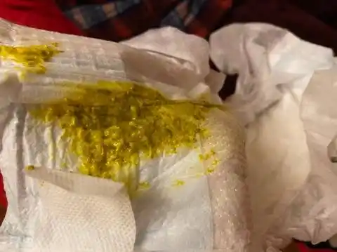 50天宝宝一天拉5次这种便便,是受凉和消化不良吗,我