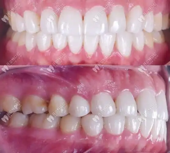 正常牙齿咬合图