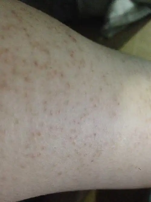 手臂皮肤不知道怎么出现黑点,不痛不痒的,请各位大神帮忙看一下,这个