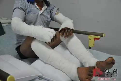 徐老汉四肢缠满纱布坐在病床上.